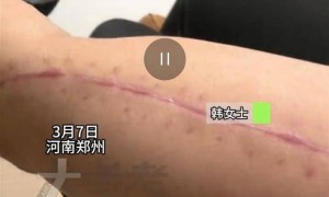 27岁女子参加掰手腕比赛，“咔嚓”一声手臂断了！医生：与对手强弱无关